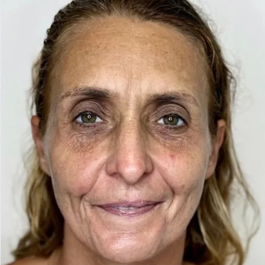 Antes — Harmonização Facial